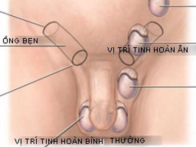 Mổ nội soi tinh hoàn ẩn